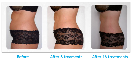 Laser Lipo Phoenix